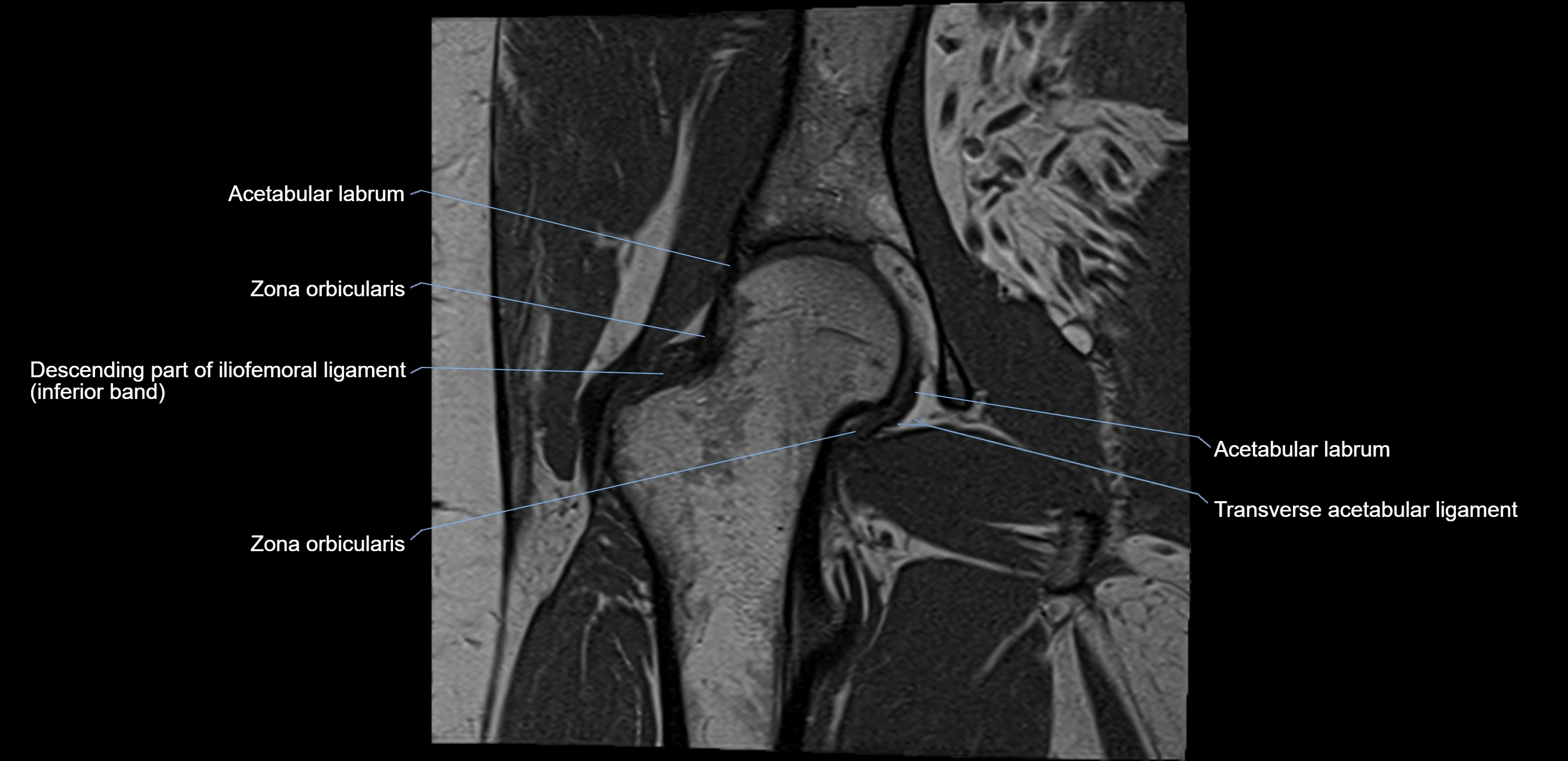 MRI Hip ligaments coronal cross sectional anatomy 3T  radiology  image-img-00001-00014.webp